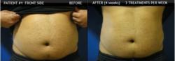 non invasive fat loss cold laser